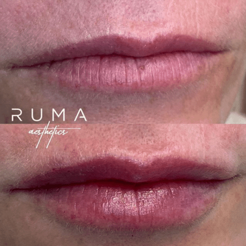 lip filler Before and After Images