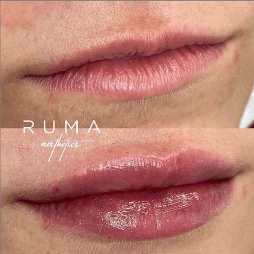 Before and After Images lip filler