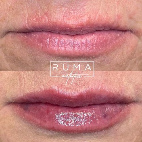 Lip filler-Ruma Medical Aesthetics - UT - RumaAesthetic