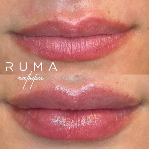 Lip filler-Ruma Medical Aesthetics - UT - RumaAesthetic