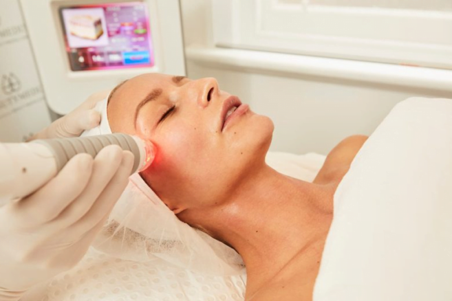 RUMA’S Vivace Microneedling With Radiofrequency Treatment