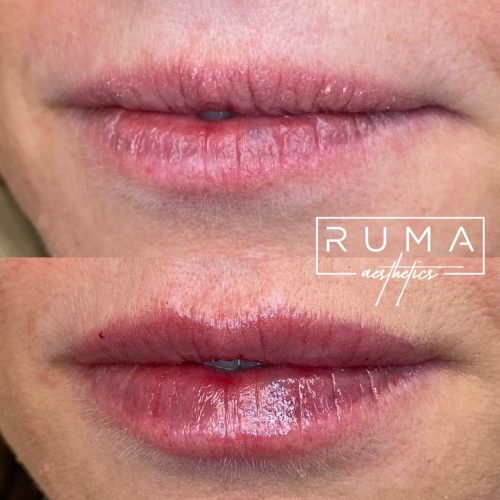 Lip Filler Before and After Images