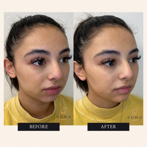 Chin Filler Before and After Images