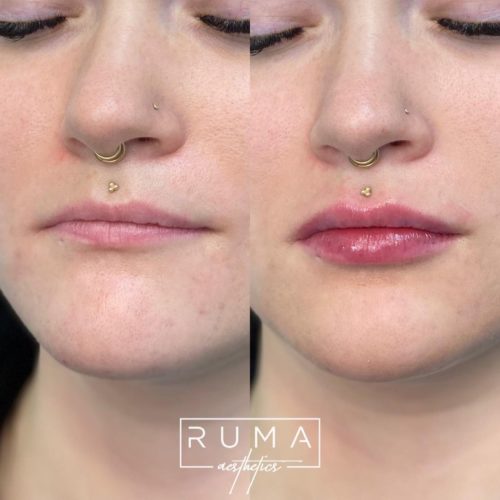 Lip Filler Before and After Images
