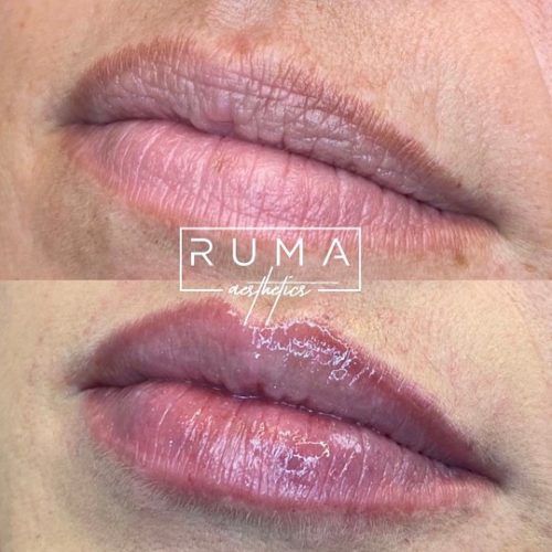 Lip Hydrate Before and After Images