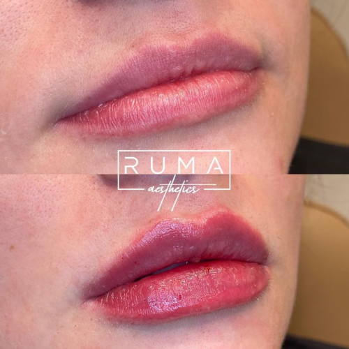 Lip Filler-Ruma Medical Aesthetics - UT - RumaAesthetic