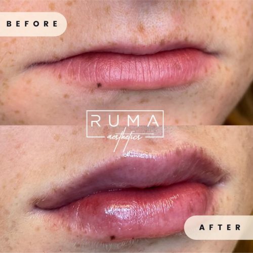 Lip filler augmentation Before and After