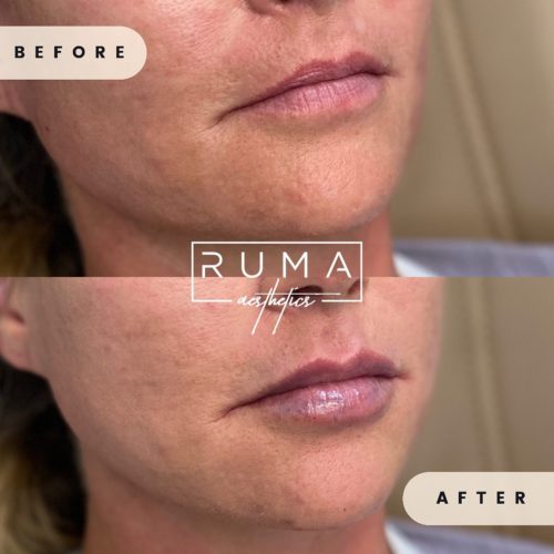 Lips Plastic Surgery-Ruma Medical Aesthetics - UT - RumaAesthetic