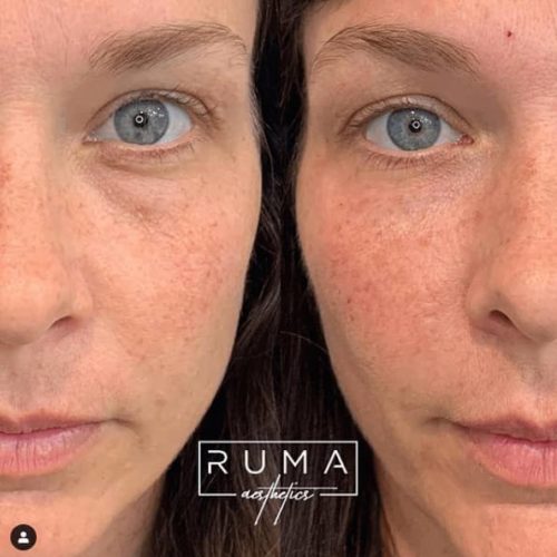 Before and After Images UT -Ruma Aesthetic Four