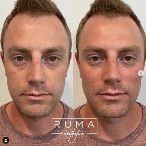 Before and After Images-UT -Ruma Aesthetics Fourteen
