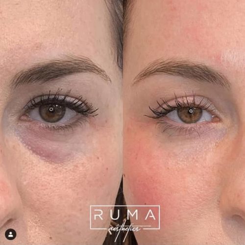Before and After Images-UT -Ruma Aestheti- Thirteen