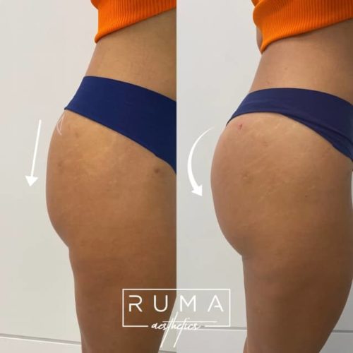 Butt lift with PDO threads - UT -Ruma Aesthetics
