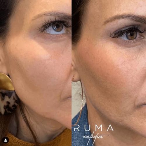 sculptra before and after - UT - Ruma Aesthetic