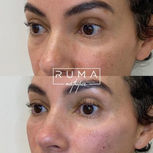Signature-Before-and-After-Images_One-ut-ruma-aesthetics