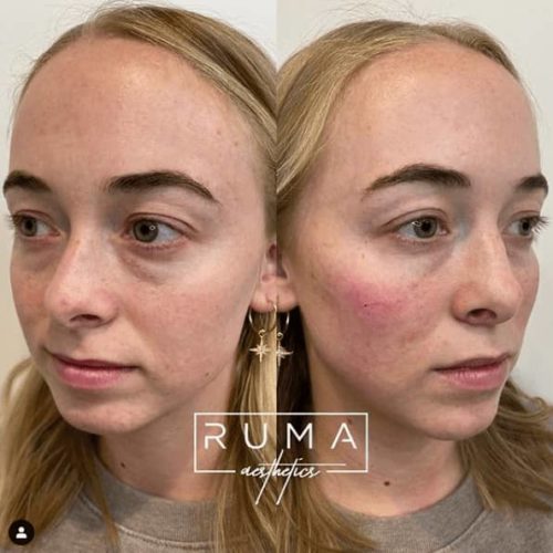 Signature Tear through & cheek filler - UT - Ruma Aesthetics